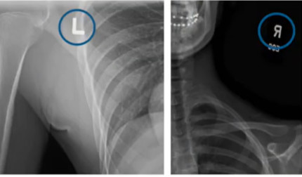 Rendgenski snimci otkrivaju: Kada je kriva kičma kod dece alarm