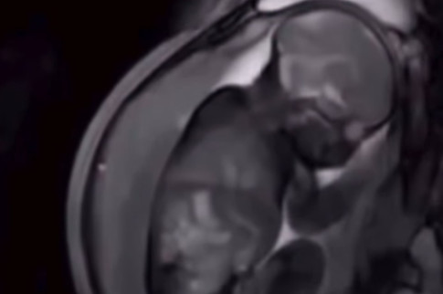 Zašto bebe vole tapkanje dok tonu u san? Babica Radmila dala jednostavno objašnjenje koje će razumeti svaki roditelj
