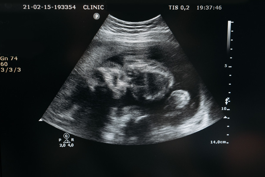 Placenta u trudnoći: Najvažniji organ koji hrani, štiti i oblikuje razvoj vaše bebe