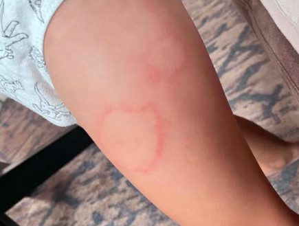 Mama pokazala neobične fleke po celom telu deteta: Pljušte komentari, ali je druga mama objasnila