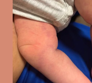„Pojavila se modrica na bebinoj nozi, a nije se udarila“ Zabrinuta mama na mreži saznala šta ovo može biti
