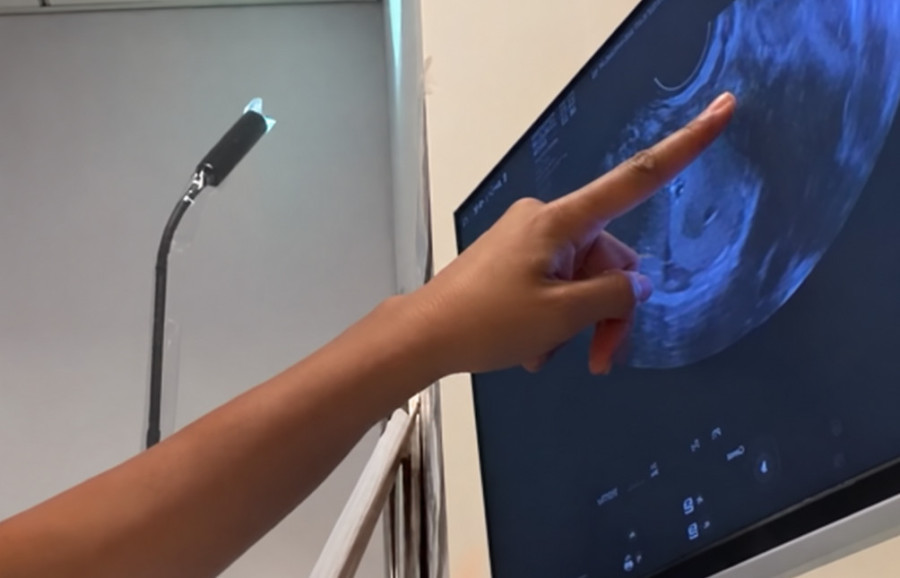 Na ultrazvuku su joj videli samo dva folikula, a ona se uplašila: Lekari otkrivaju zašto ovaj broj ne mora da znači kraj nade za bebu